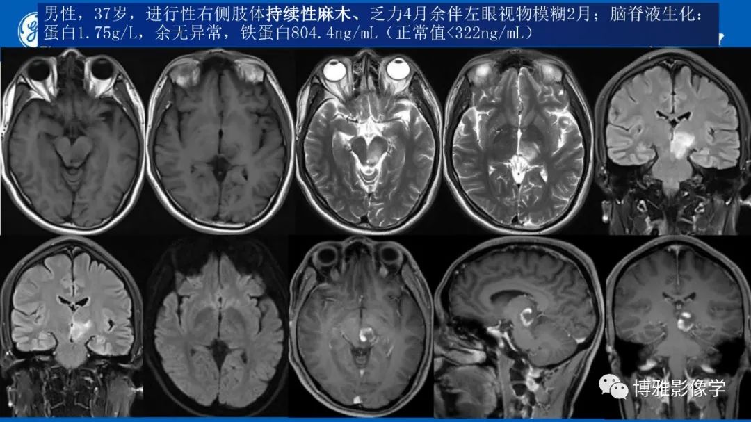 影像PPT - 【PPT】临影结合看图识病之单侧基底节病变解析-2