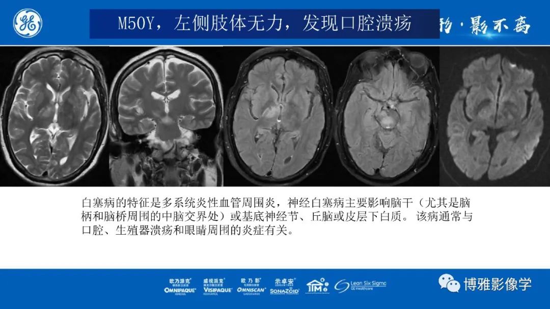 影像PPT - 【PPT】临影结合看图识病之单侧基底节病变解析-4