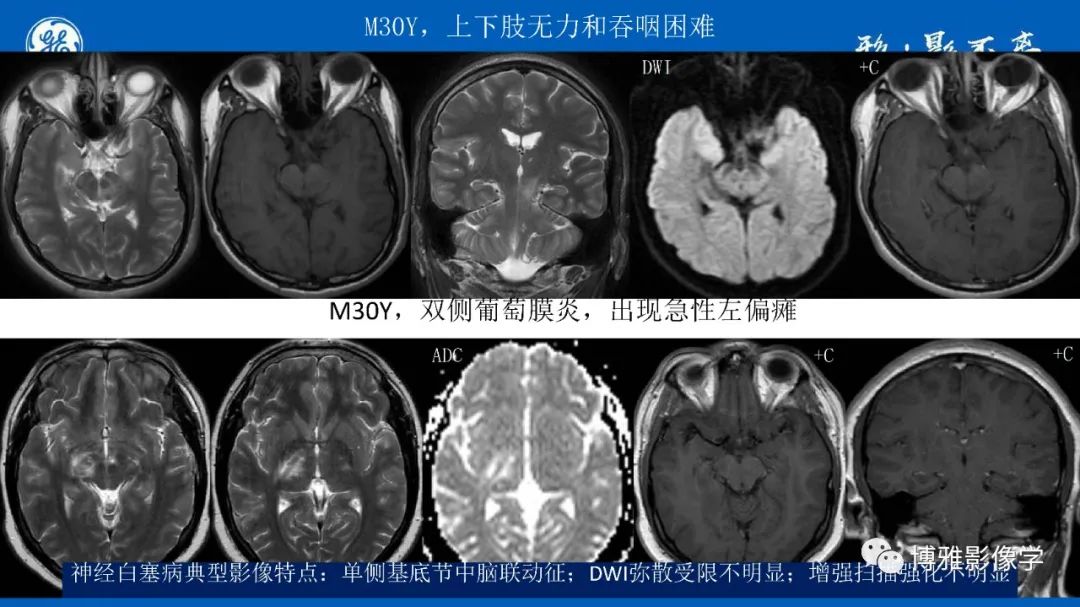 影像PPT - 【PPT】临影结合看图识病之单侧基底节病变解析-5