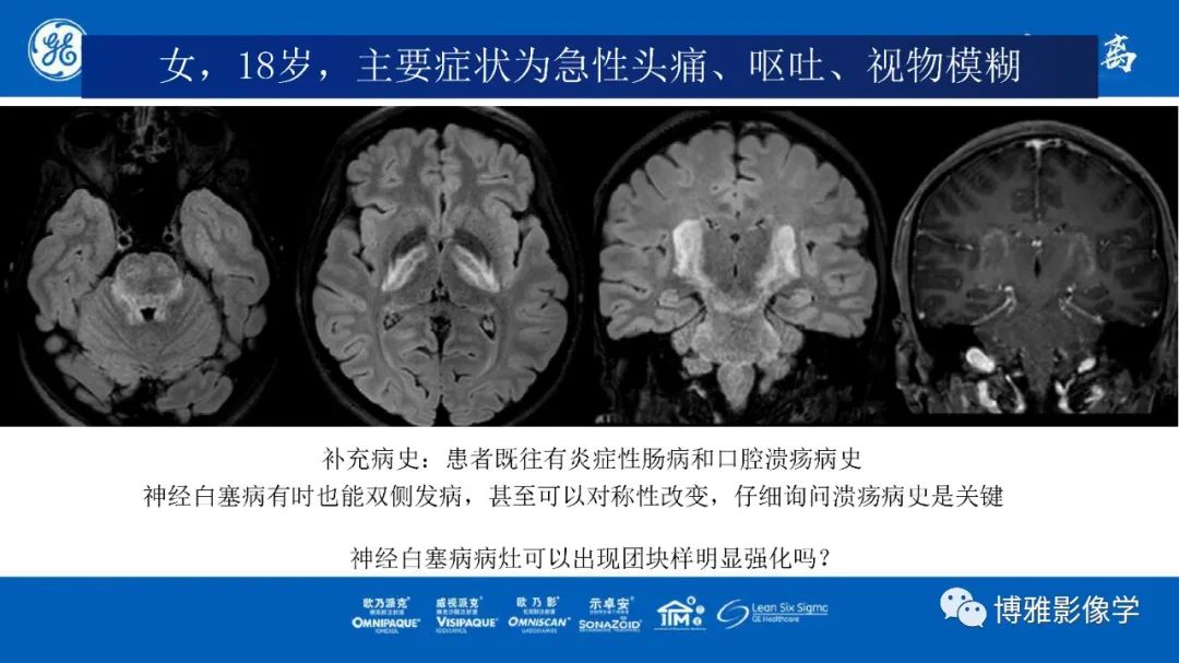 影像PPT - 【PPT】临影结合看图识病之单侧基底节病变解析-6