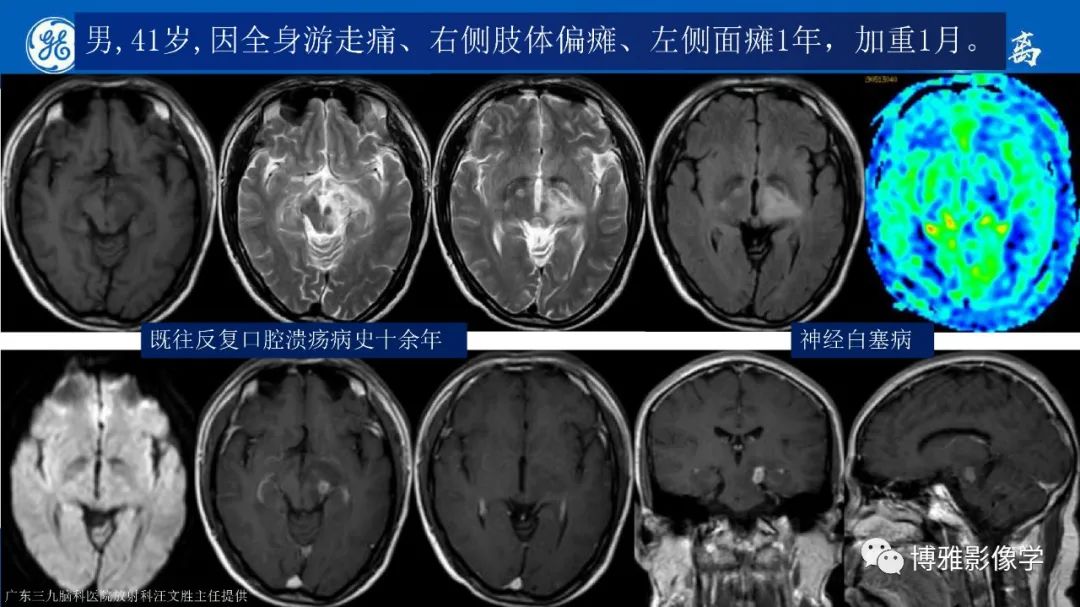 影像PPT - 【PPT】临影结合看图识病之单侧基底节病变解析-7