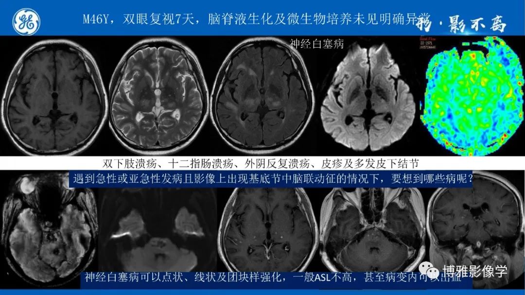 影像PPT - 【PPT】临影结合看图识病之单侧基底节病变解析-8