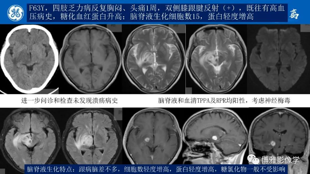 影像PPT - 【PPT】临影结合看图识病之单侧基底节病变解析-9