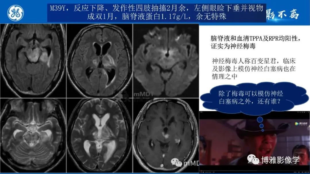 影像PPT - 【PPT】临影结合看图识病之单侧基底节病变解析-10