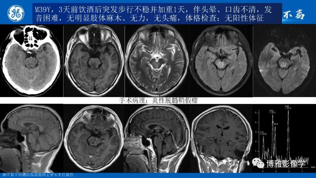 影像PPT - 【PPT】临影结合看图识病之单侧基底节病变解析-11