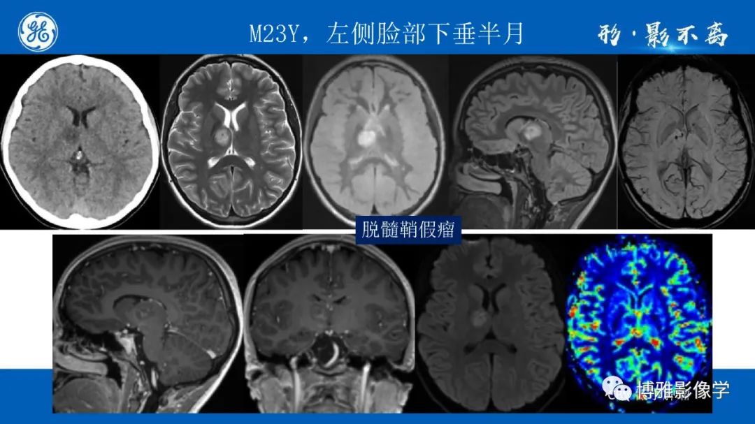 影像PPT - 【PPT】临影结合看图识病之单侧基底节病变解析-12