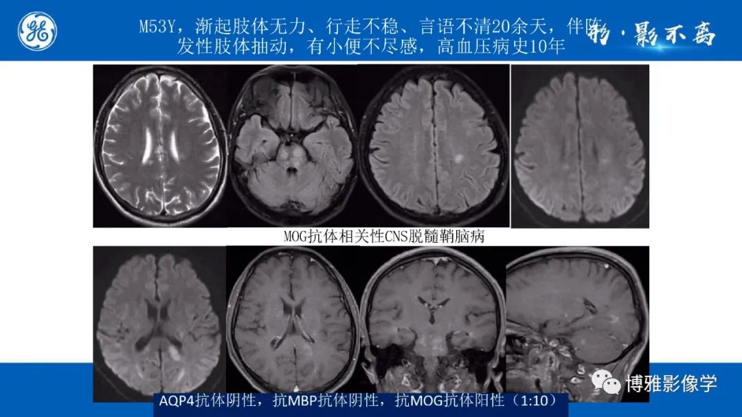 影像PPT - 【PPT】临影结合看图识病之单侧基底节病变解析-13