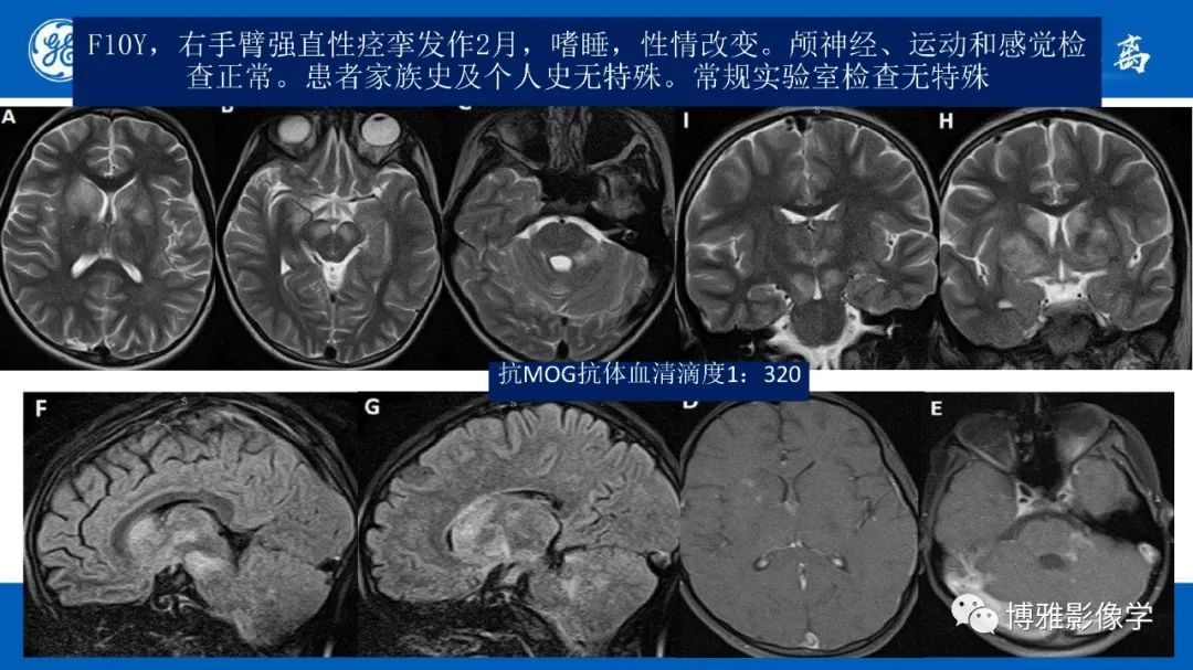 影像PPT - 【PPT】临影结合看图识病之单侧基底节病变解析-14