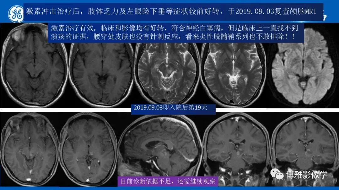 影像PPT - 【PPT】临影结合看图识病之单侧基底节病变解析-17