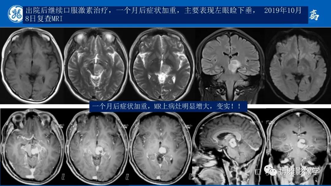 影像PPT - 【PPT】临影结合看图识病之单侧基底节病变解析-18