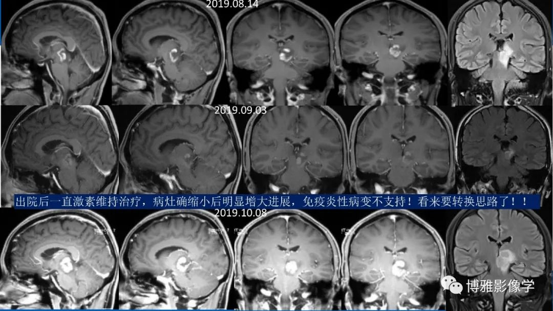 影像PPT - 【PPT】临影结合看图识病之单侧基底节病变解析-19