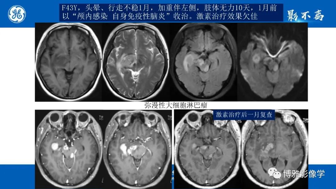 影像PPT - 【PPT】临影结合看图识病之单侧基底节病变解析-21
