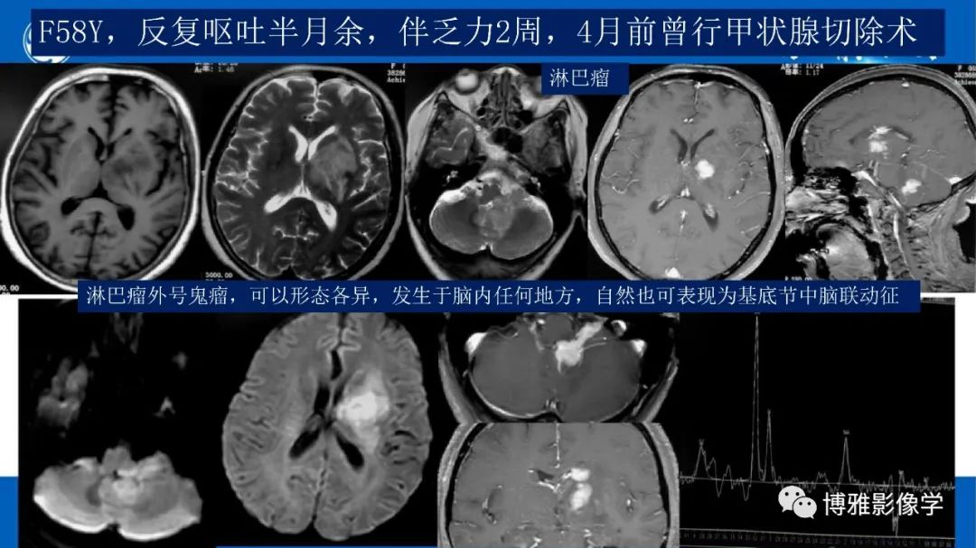 影像PPT - 【PPT】临影结合看图识病之单侧基底节病变解析-22