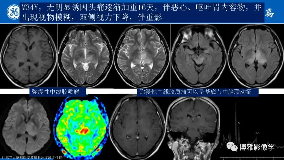 影像PPT - 【PPT】临影结合看图识病之单侧基底节病变解析-24