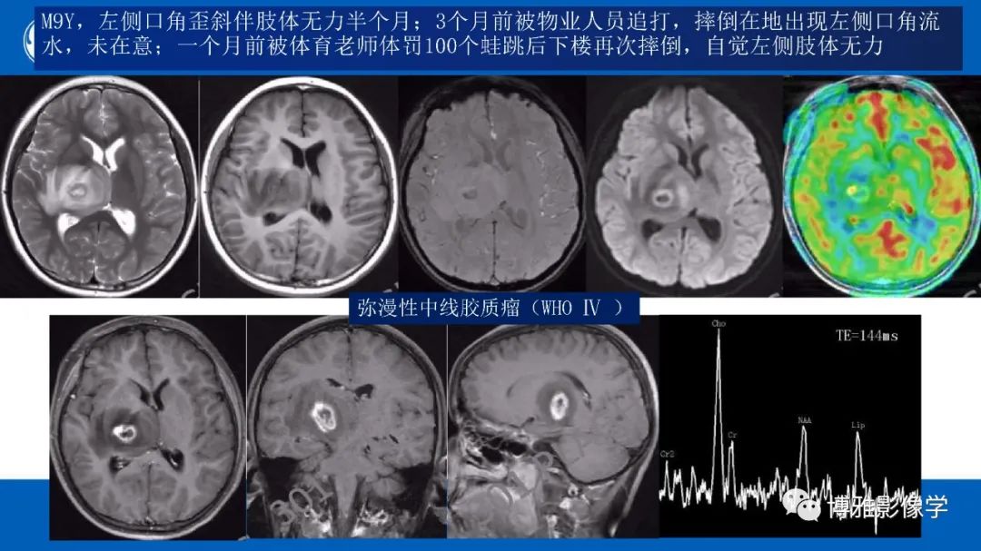 影像PPT - 【PPT】临影结合看图识病之单侧基底节病变解析-25