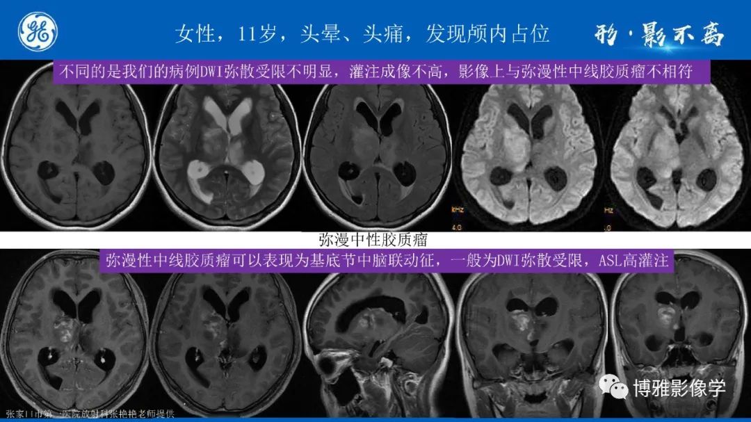 影像PPT - 【PPT】临影结合看图识病之单侧基底节病变解析-26