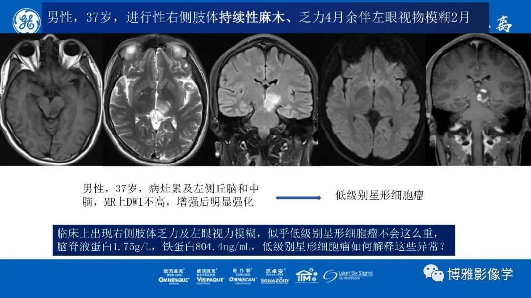 影像PPT - 【PPT】临影结合看图识病之单侧基底节病变解析-28