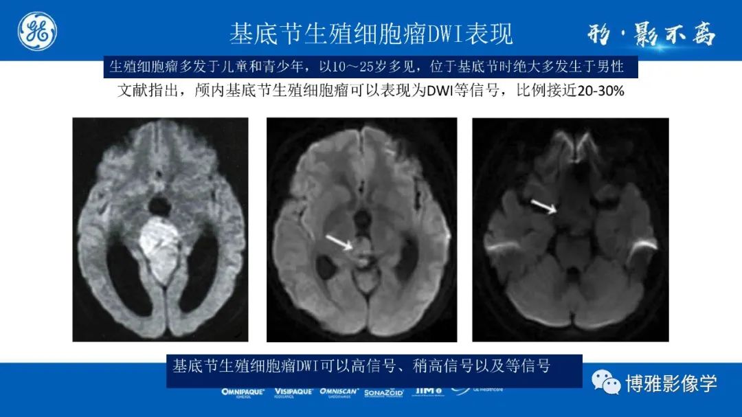 影像PPT - 【PPT】临影结合看图识病之单侧基底节病变解析-30