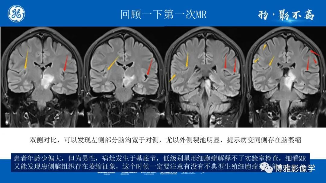 影像PPT - 【PPT】临影结合看图识病之单侧基底节病变解析-29
