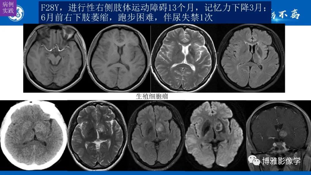 影像PPT - 【PPT】临影结合看图识病之单侧基底节病变解析-32