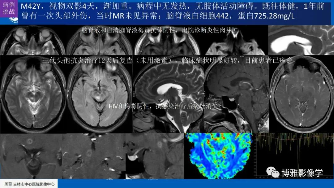 影像PPT - 【PPT】临影结合看图识病之单侧基底节病变解析-33