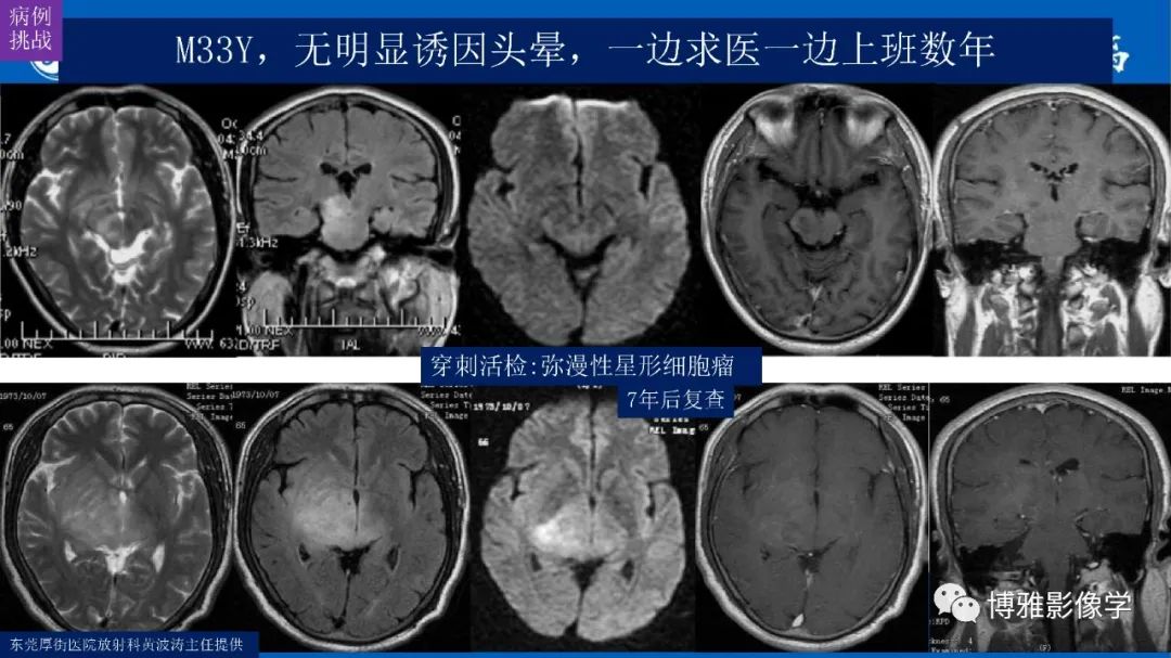 影像PPT - 【PPT】临影结合看图识病之单侧基底节病变解析-34