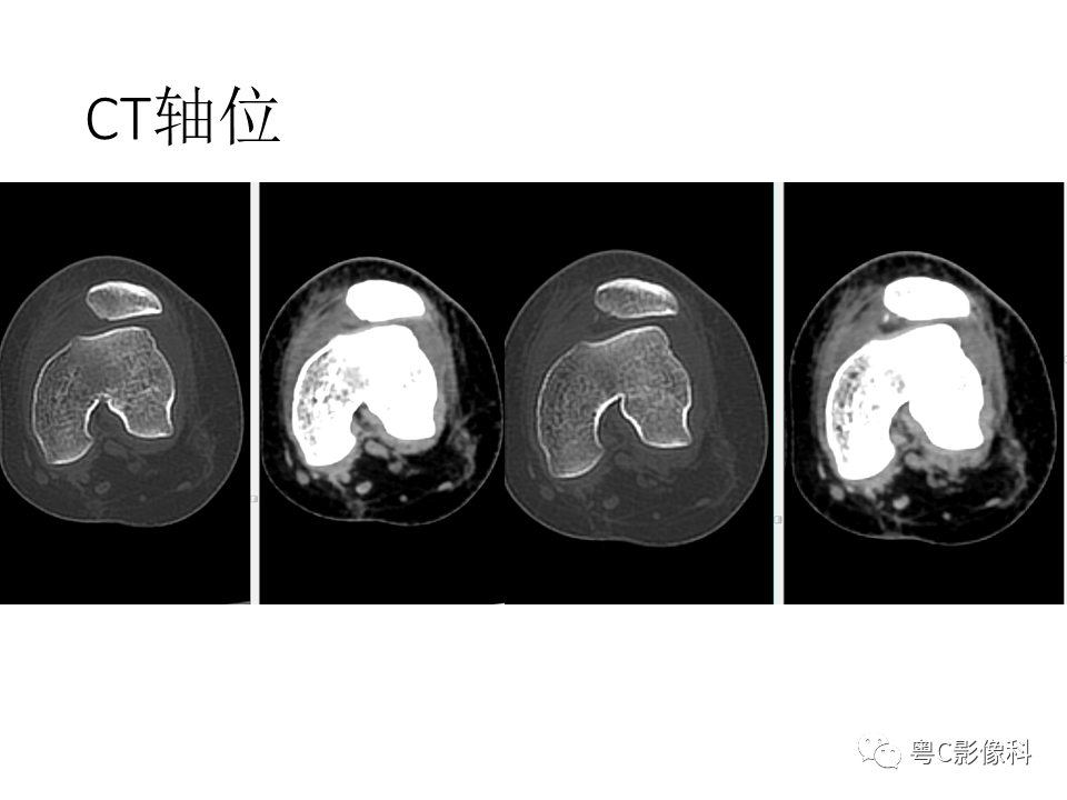 影像PPT - 【病例】一过性髌骨脱位1例CT及MR影像表现-3 影像PPT - 【病例】一过性髌骨脱位1例CT及MR影像表现-3