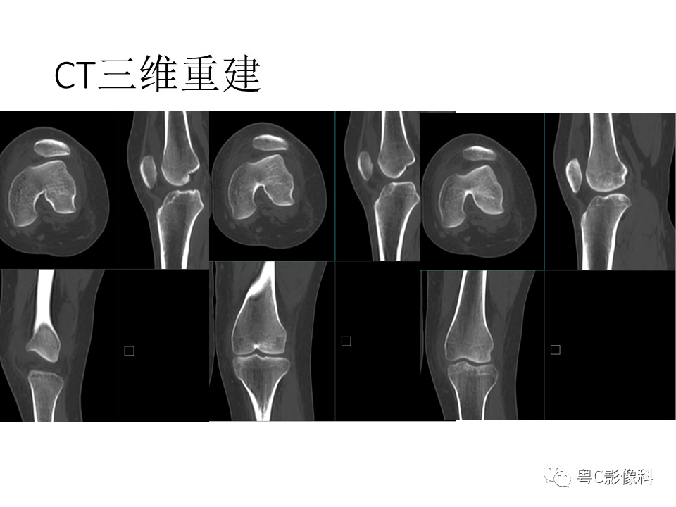 影像PPT - 【病例】一过性髌骨脱位1例CT及MR影像表现-6 影像PPT - 【病例】一过性髌骨脱位1例CT及MR影像表现-6