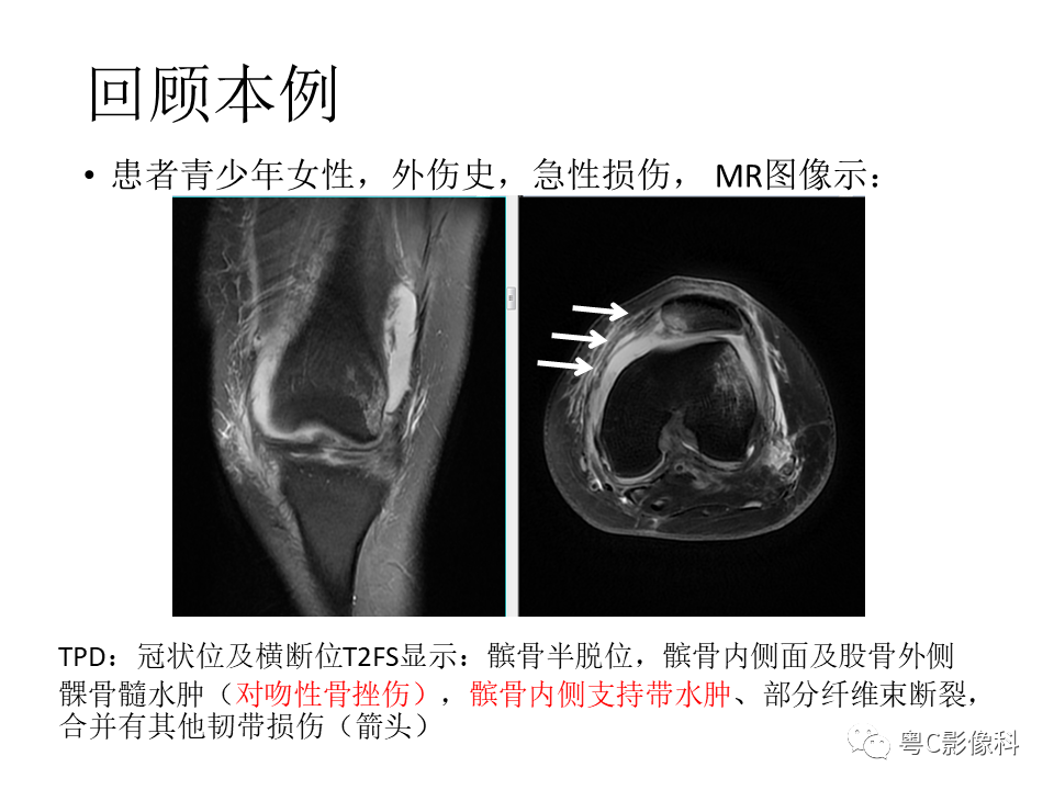 影像PPT - 【病例】一过性髌骨脱位1例CT及MR影像表现-15 影像PPT - 【病例】一过性髌骨脱位1例CT及MR影像表现-15