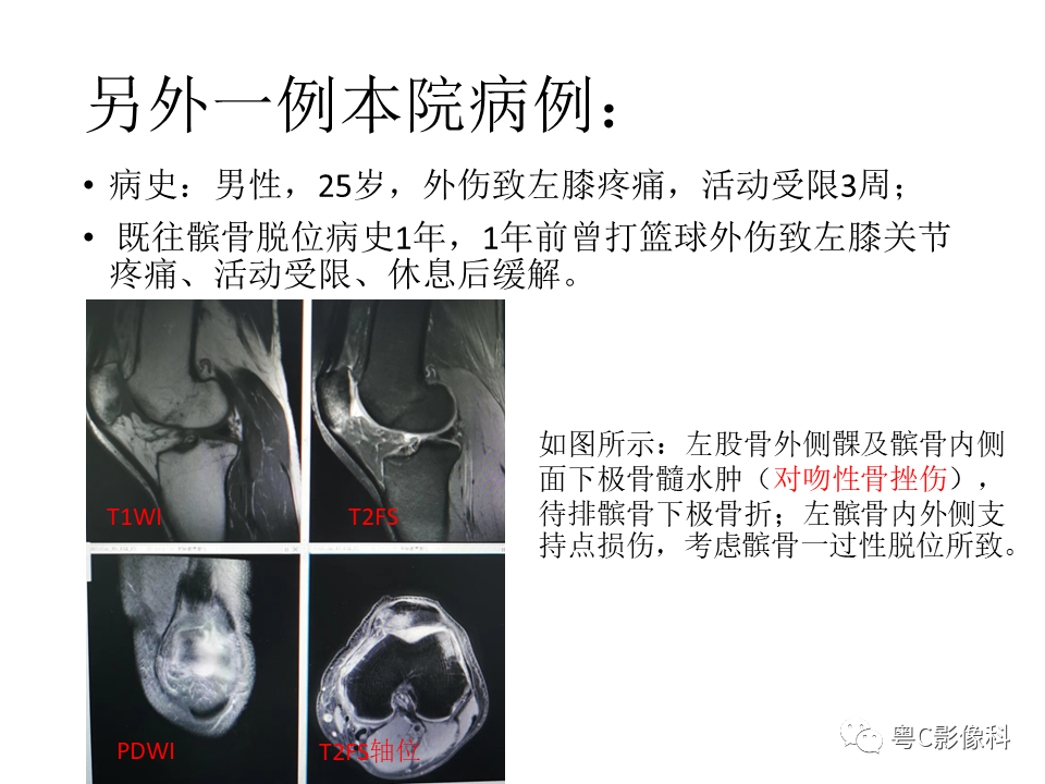 影像PPT - 【病例】一过性髌骨脱位1例CT及MR影像表现-16 影像PPT - 【病例】一过性髌骨脱位1例CT及MR影像表现-16