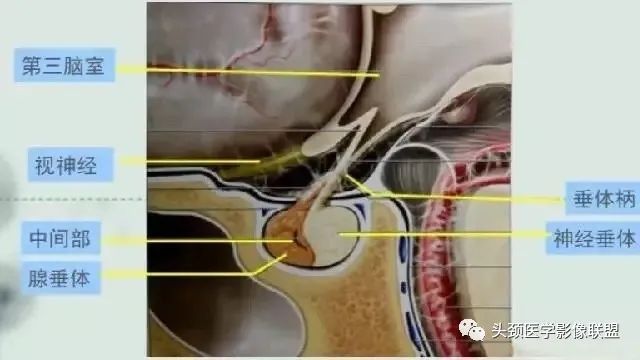 影像PPT - 垂体腺瘤的“丛征”-1 影像PPT - 垂体腺瘤的“丛征”-1