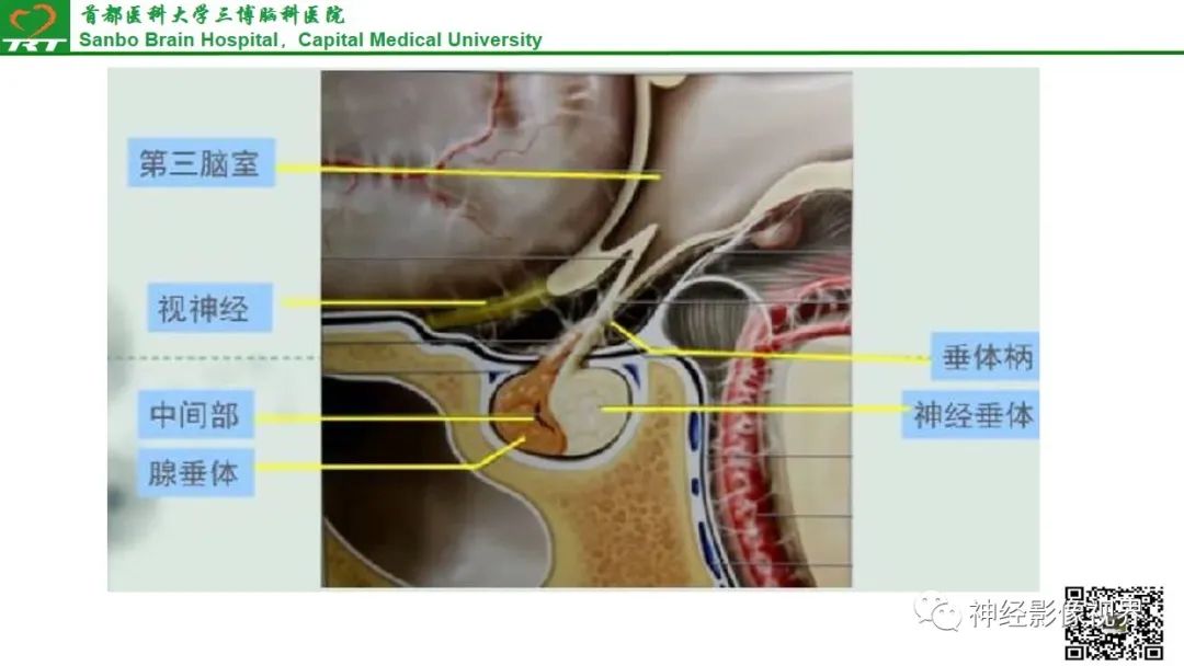 影像PPT - 垂体腺瘤的“丛征”-10 影像PPT - 垂体腺瘤的“丛征”-10
