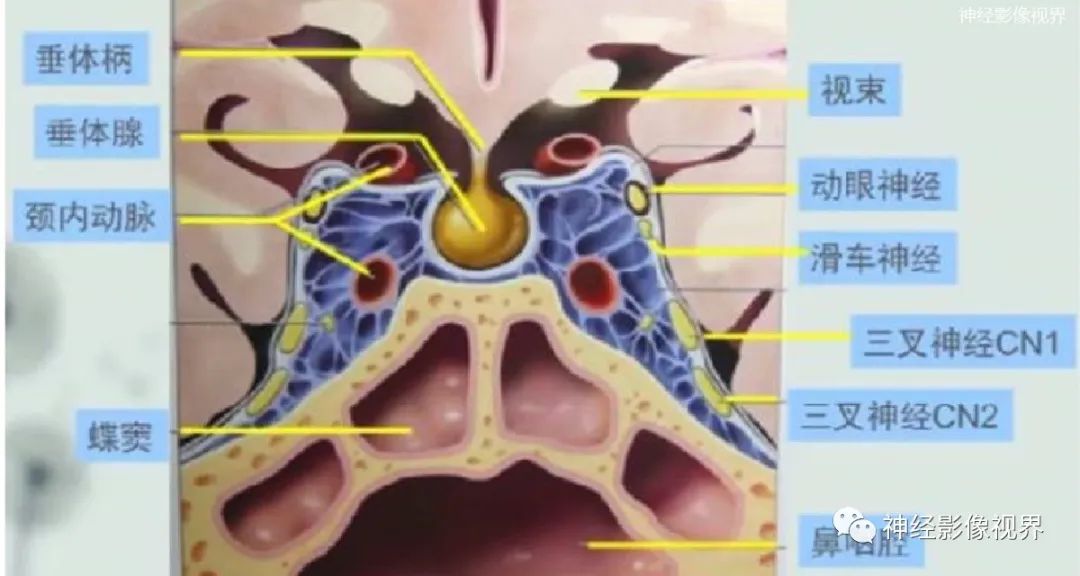 影像PPT - 垂体腺瘤的“丛征”-11 影像PPT - 垂体腺瘤的“丛征”-11