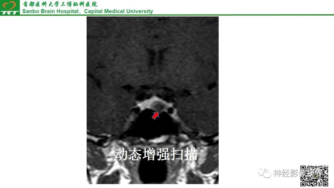 影像PPT - 垂体腺瘤的“丛征”-17 影像PPT - 垂体腺瘤的“丛征”-17