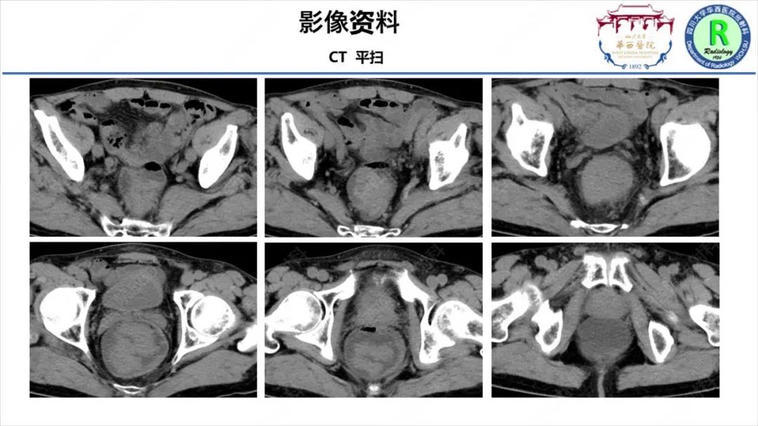 影像PPT - 【病例】McKittrick–Wheelock综合征1例CT及MR影像-4