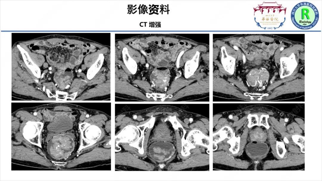 影像PPT - 【病例】McKittrick–Wheelock综合征1例CT及MR影像-5
