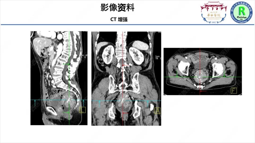 影像PPT - 【病例】McKittrick–Wheelock综合征1例CT及MR影像-6