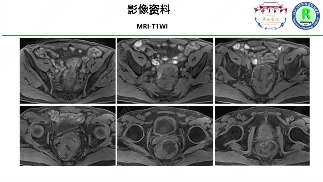 影像PPT - 【病例】McKittrick–Wheelock综合征1例CT及MR影像-7