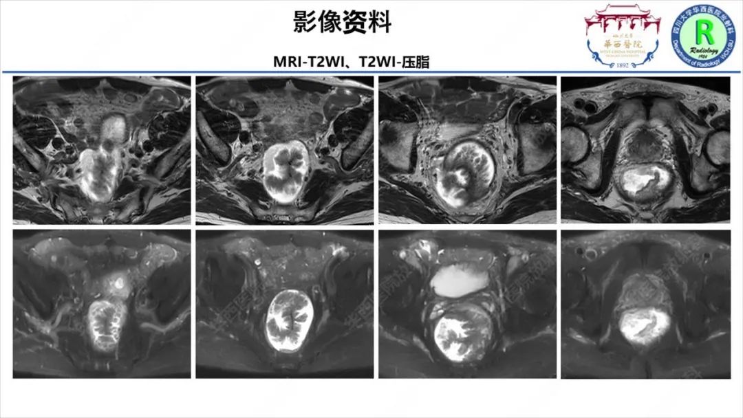 影像PPT - 【病例】McKittrick–Wheelock综合征1例CT及MR影像-8