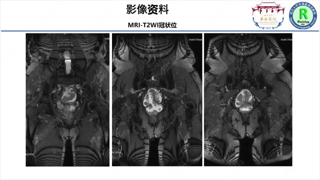 影像PPT - 【病例】McKittrick–Wheelock综合征1例CT及MR影像-9