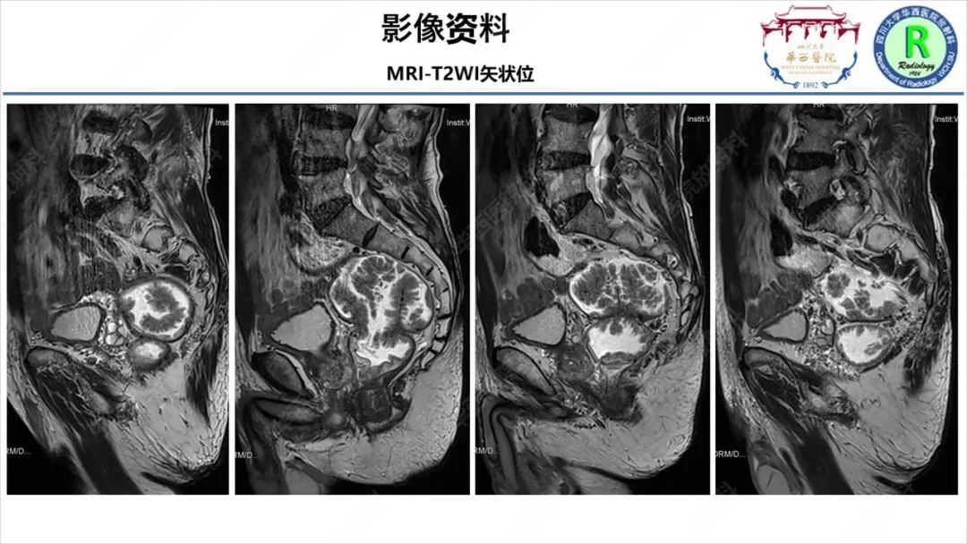 影像PPT - 【病例】McKittrick–Wheelock综合征1例CT及MR影像-10