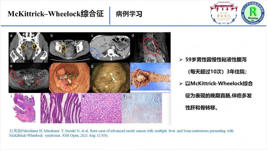 影像PPT - 【病例】McKittrick–Wheelock综合征1例CT及MR影像-19