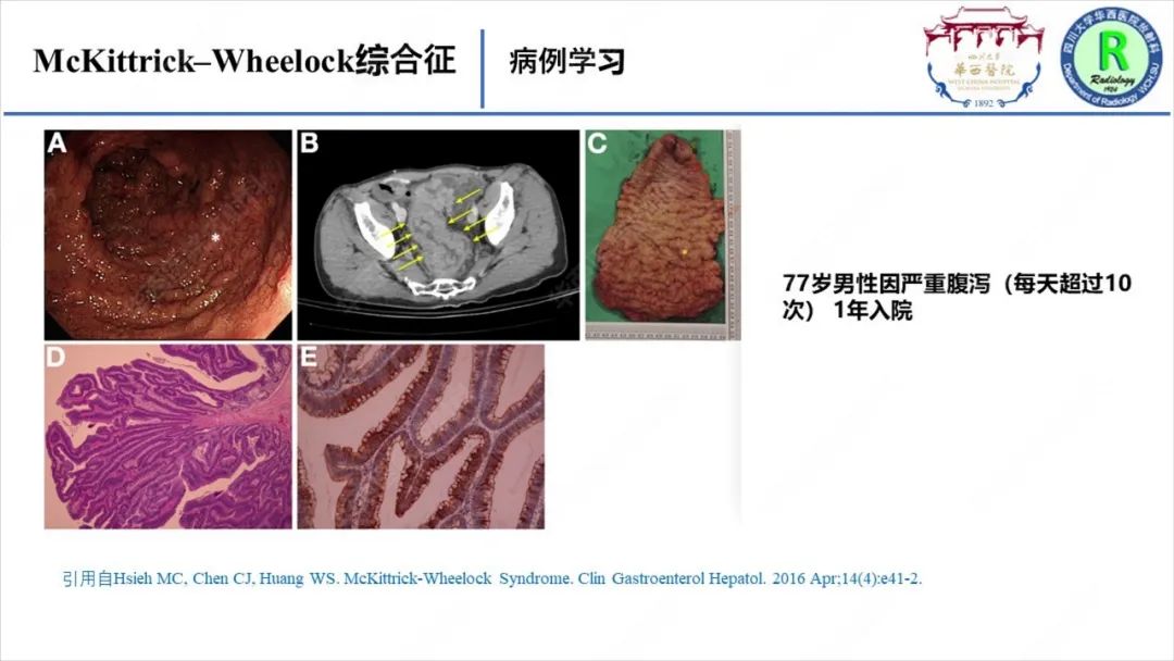 影像PPT - 【病例】McKittrick–Wheelock综合征1例CT及MR影像-20