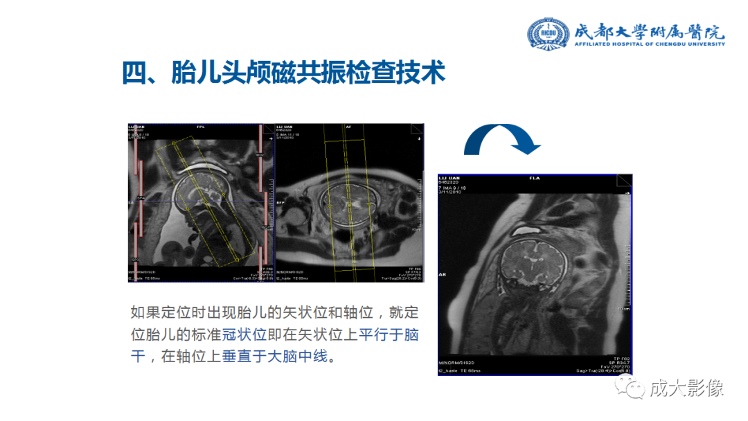 影像PPT - 【PPT】婴幼儿及胎儿头颅MRI成像要点-18