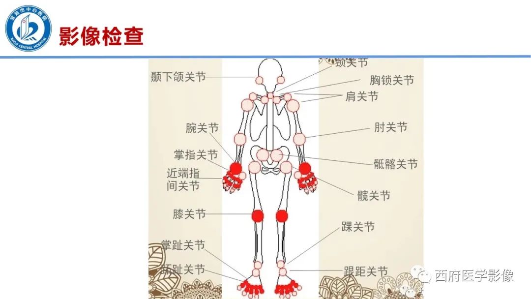 影像PPT - 【PPT】类风湿性关节炎的早期影像学诊断-9