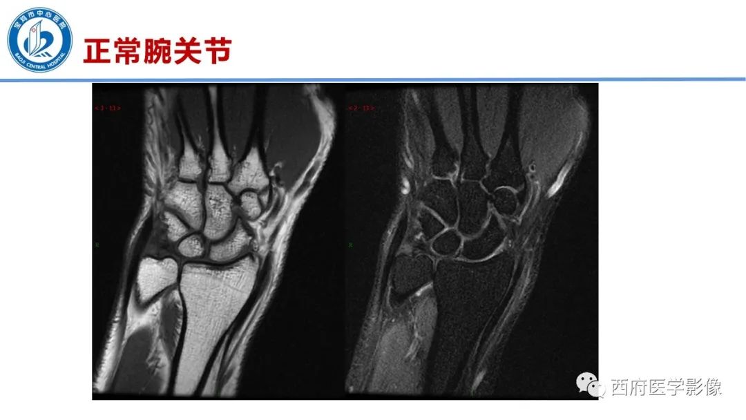影像PPT - 【PPT】类风湿性关节炎的早期影像学诊断-11