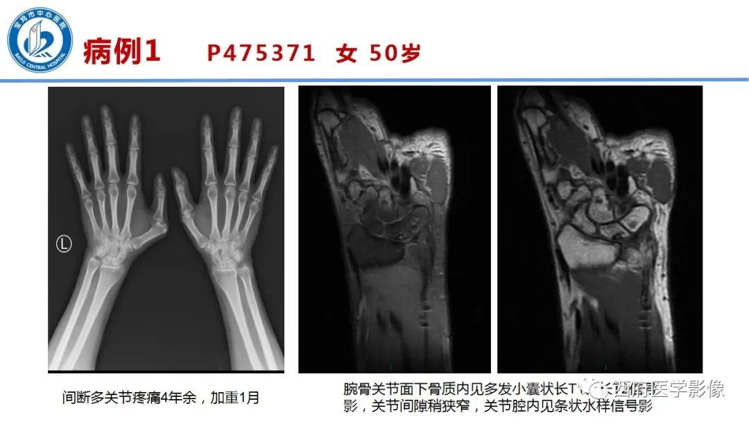 影像PPT - 【PPT】类风湿性关节炎的早期影像学诊断-12