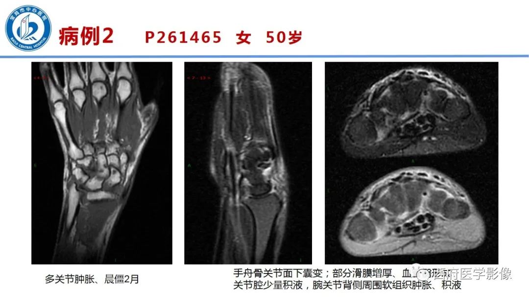 影像PPT - 【PPT】类风湿性关节炎的早期影像学诊断-13
