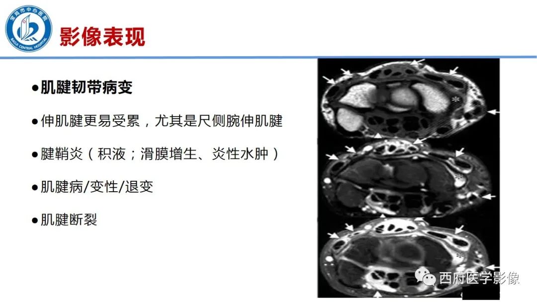 影像PPT - 【PPT】类风湿性关节炎的早期影像学诊断-14