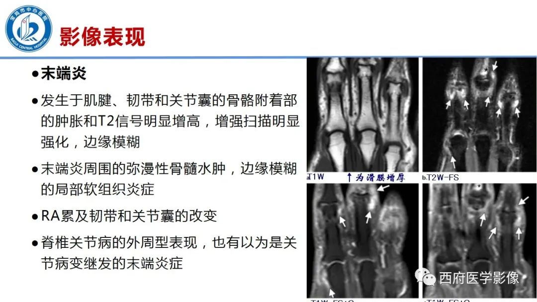 影像PPT - 【PPT】类风湿性关节炎的早期影像学诊断-15